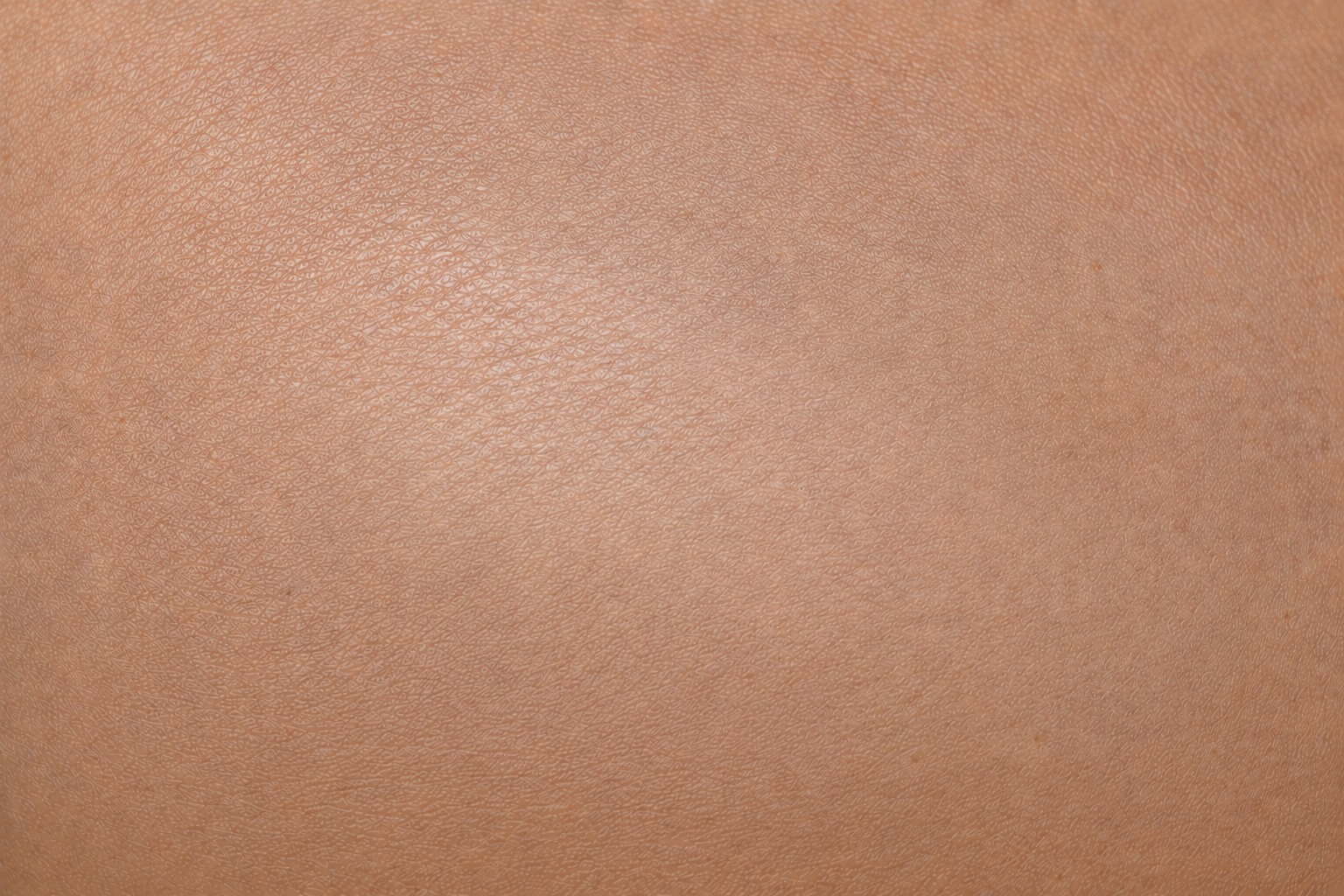 Healed skin after the EPIPROTECT® membrane has fallen off