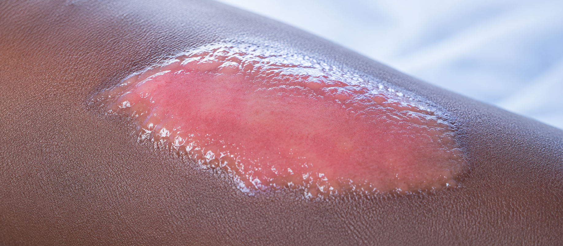 A superficial partial-thickness wound before treatment