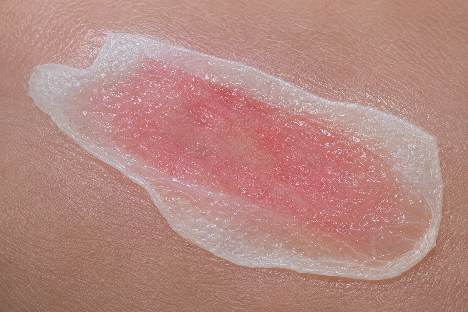 The transparent EPIPROTECT® membrane applied over the wound, conforming to the skin