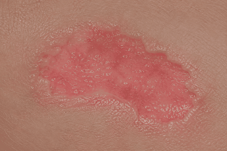 Time-lapse animation of a wound healing under a single EPIPROTECT® application