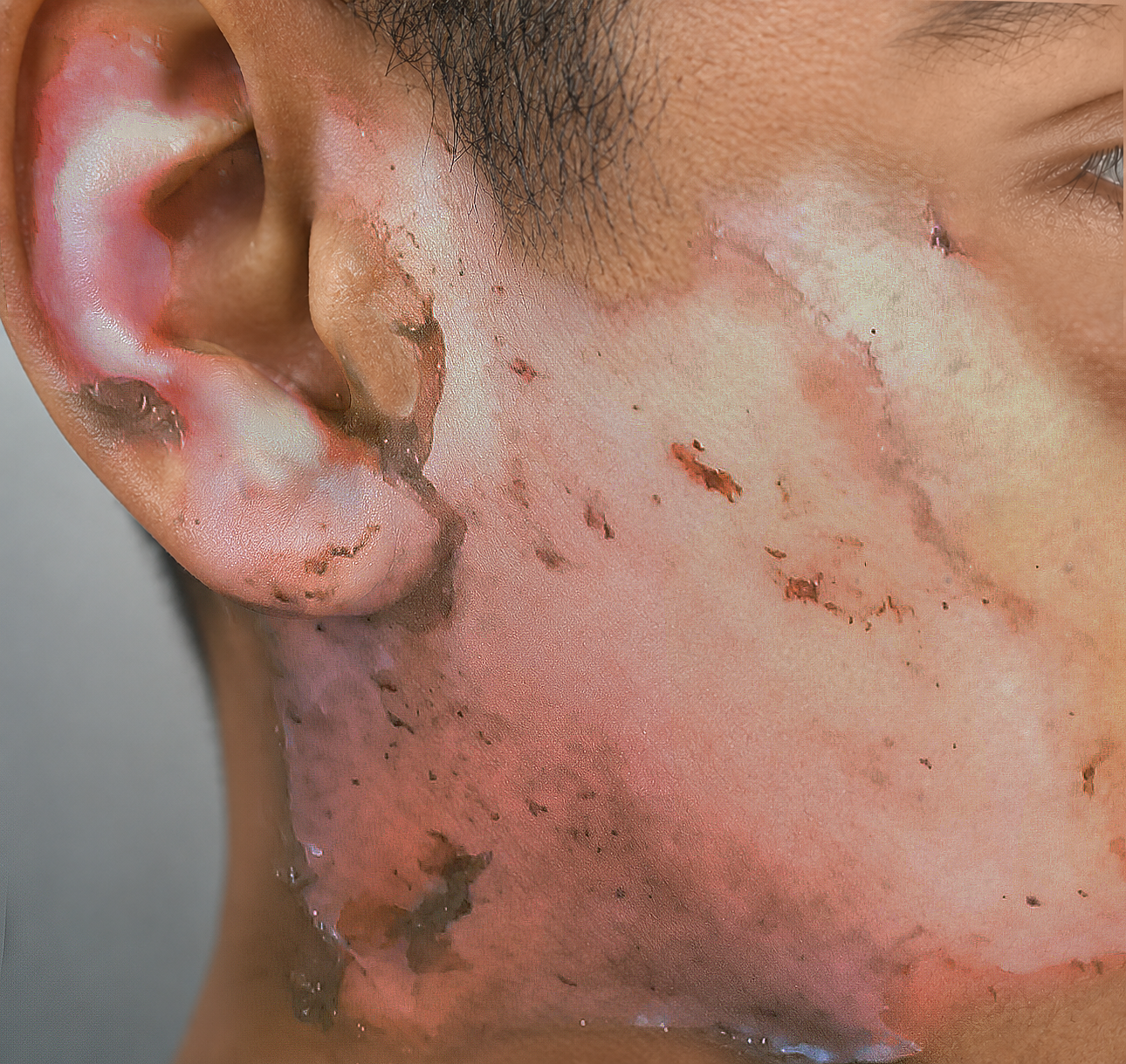 A superficial facial burn on the cheek and ear before treatment with EPIPROTECT®
