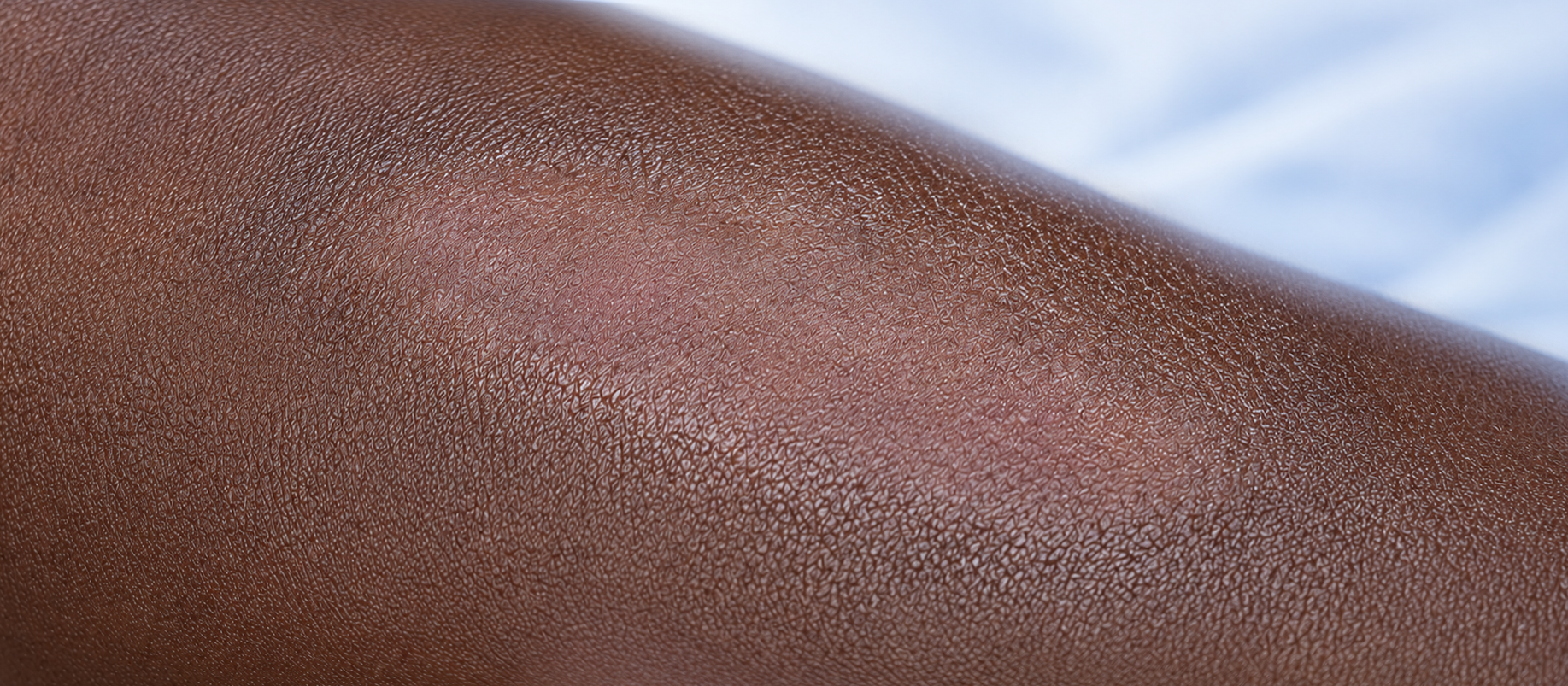 The same area of skin healed after treatment