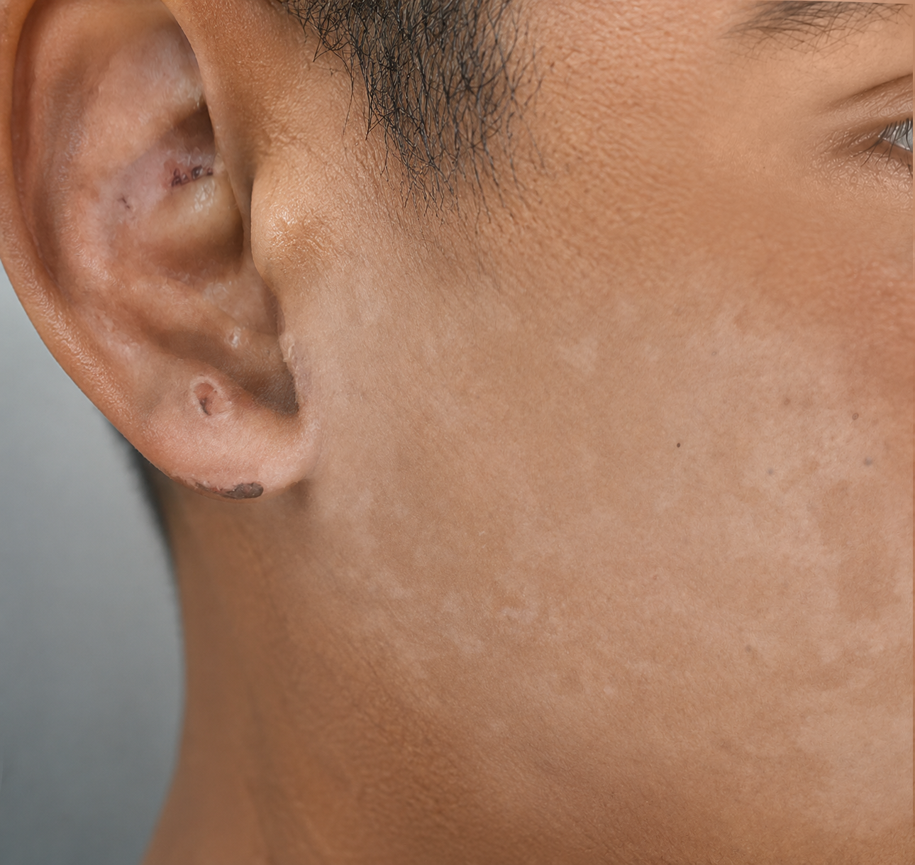 The same face healed after treatment with EPIPROTECT®
